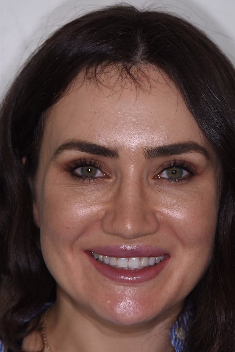 Patient Smile Before & After Gallery - Patient 233048 - Image 1