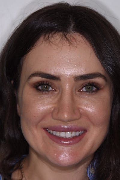 Patient Smile Before & After Gallery - Patient 233048 - Image 1