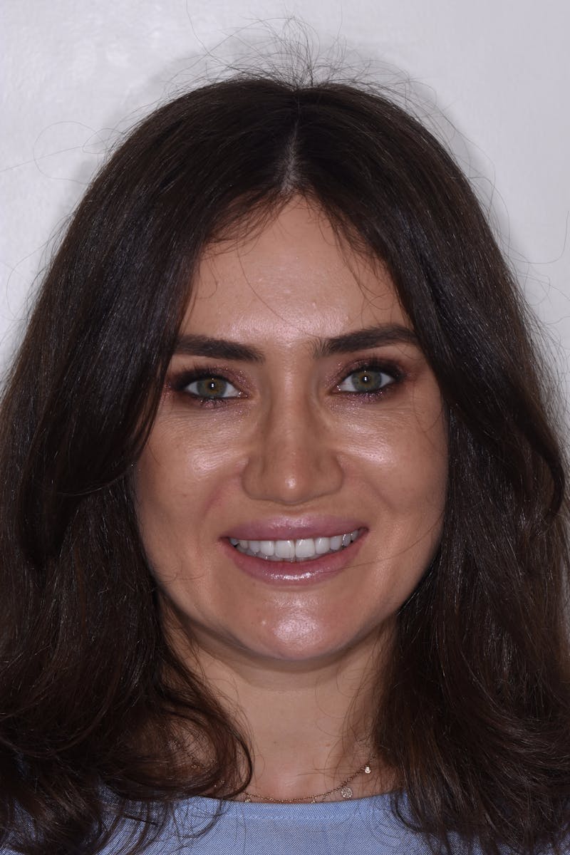 Patient Smile Before & After Gallery - Patient 233048 - Image 2