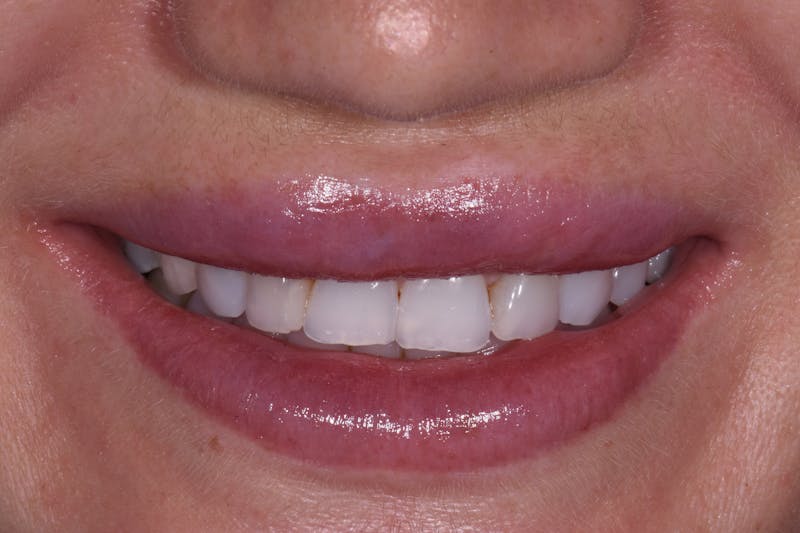 Patient Smile Before & After Gallery - Patient 233048 - Image 3