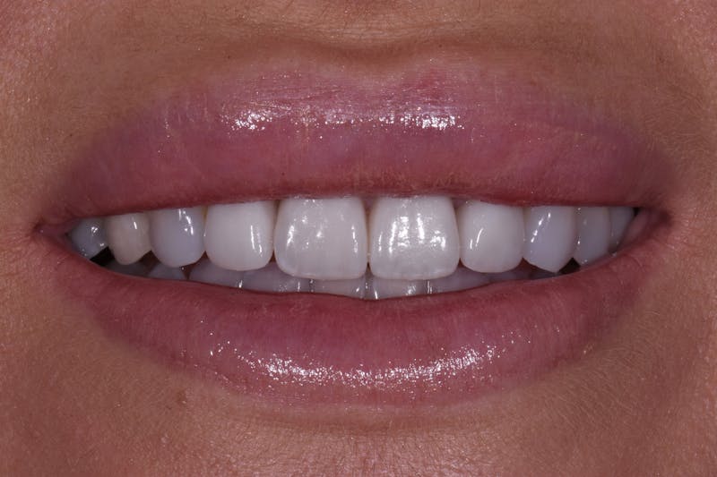 Patient Smile Before & After Gallery - Patient 233048 - Image 4