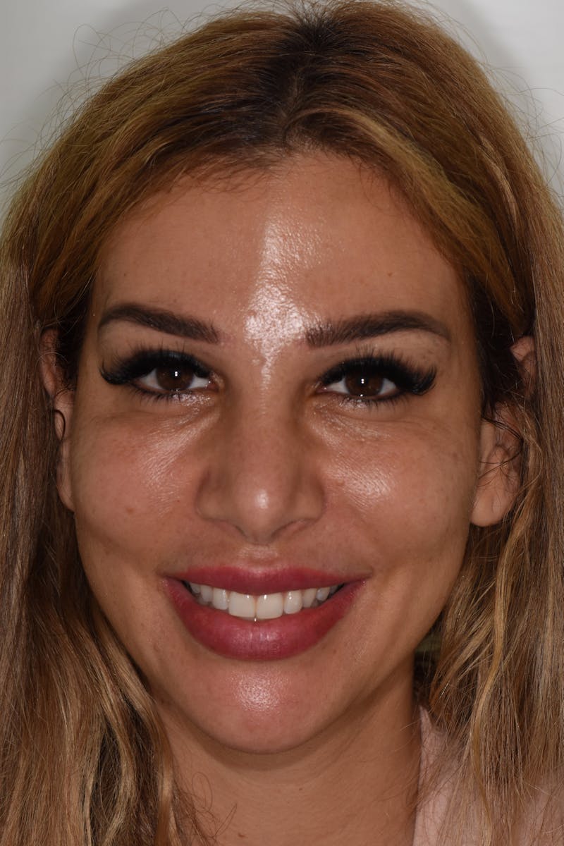 Patient Smile Before & After Gallery - Patient 142349 - Image 1