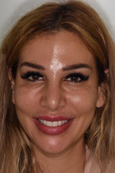 Patient Smile Before & After Gallery - Patient 142349 - Image 1