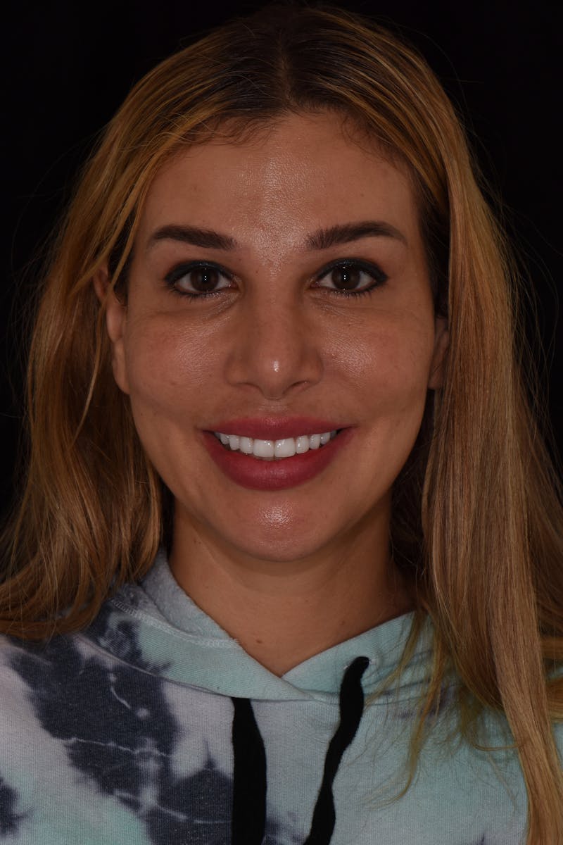 Patient Smile Before & After Gallery - Patient 142349 - Image 2