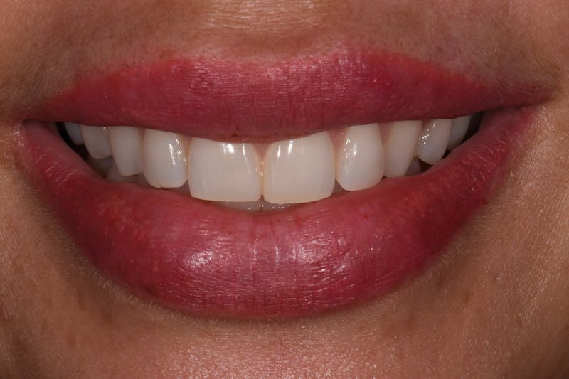Patient Smile Before & After Gallery - Patient 142349 - Image 3