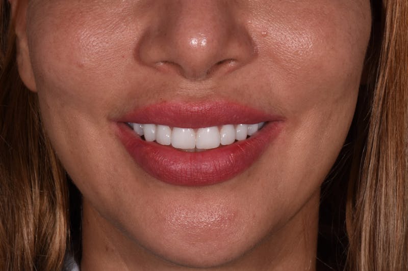 Patient Smile Before & After Gallery - Patient 142349 - Image 4