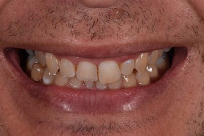Patient Smile Before & After Gallery - Patient 203158 - Image 1