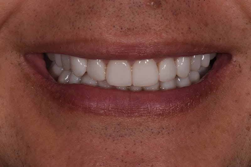 Patient Smile Before & After Gallery - Patient 203158 - Image 2