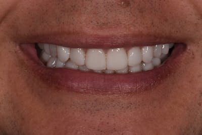 Patient Smile Before & After Gallery - Patient 203158 - Image 2