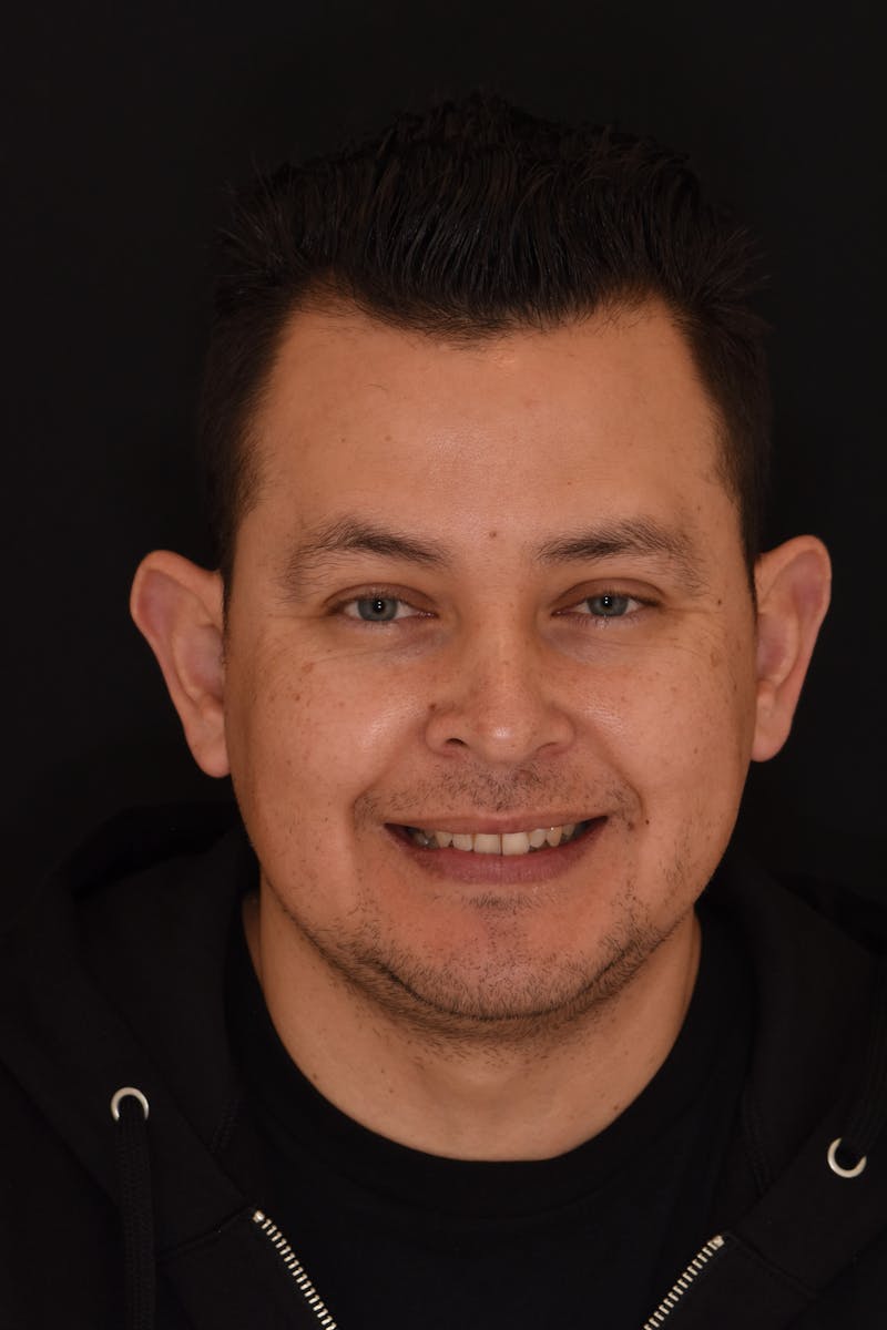 Patient Smile Before & After Gallery - Patient 202408 - Image 1