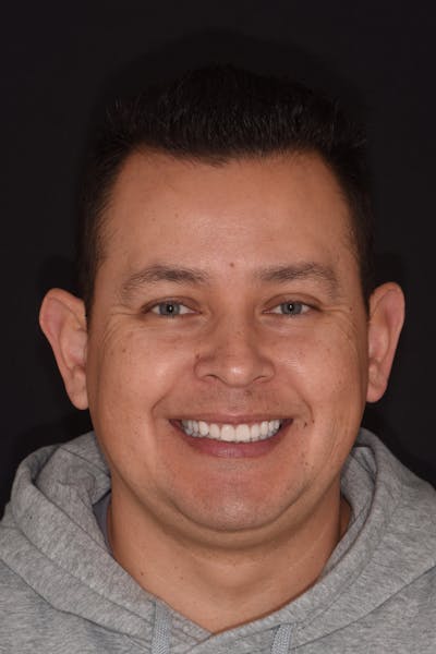 Patient Smile Before & After Gallery - Patient 202408 - Image 2