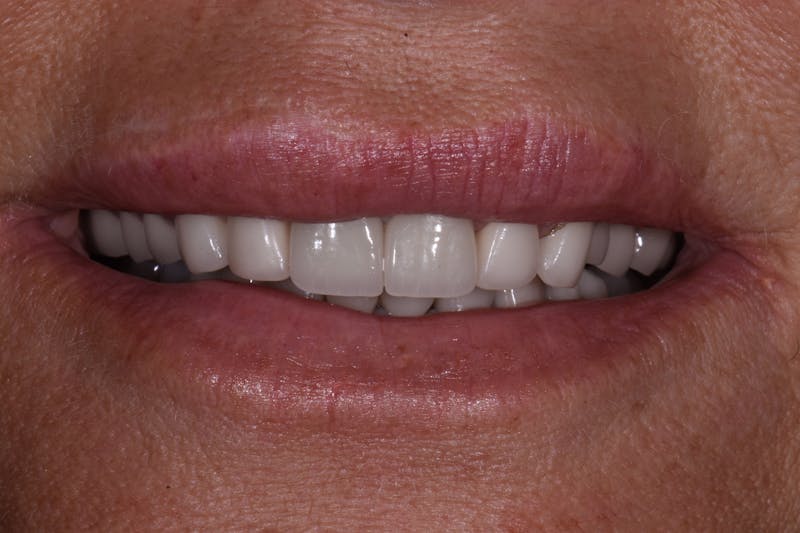 Patient Smile Before & After Gallery - Patient 332565 - Image 1