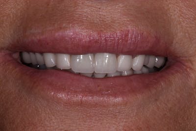 Patient Smile Before & After Gallery - Patient 332565 - Image 1