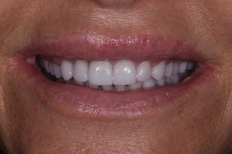 Patient Smile Before & After Gallery - Patient 332565 - Image 2