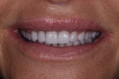 Patient Smile Before & After Gallery - Patient 332565 - Image 2
