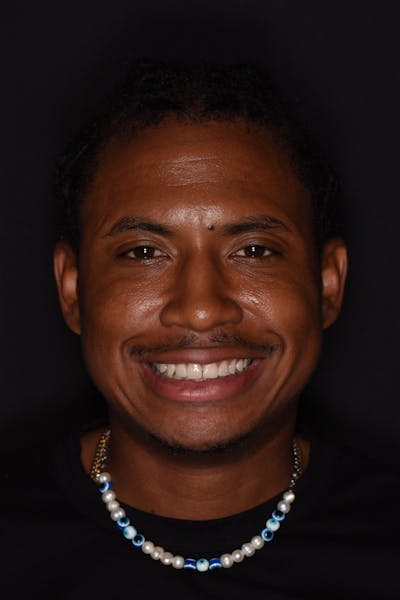 Patient Smile Before & After Gallery - Patient 107051 - Image 2