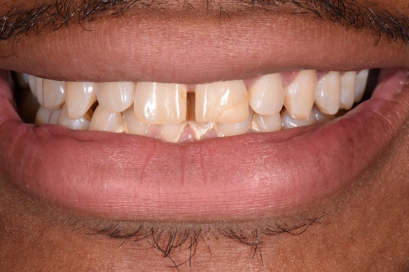 Patient Smile Before & After Gallery - Patient 107051 - Image 3