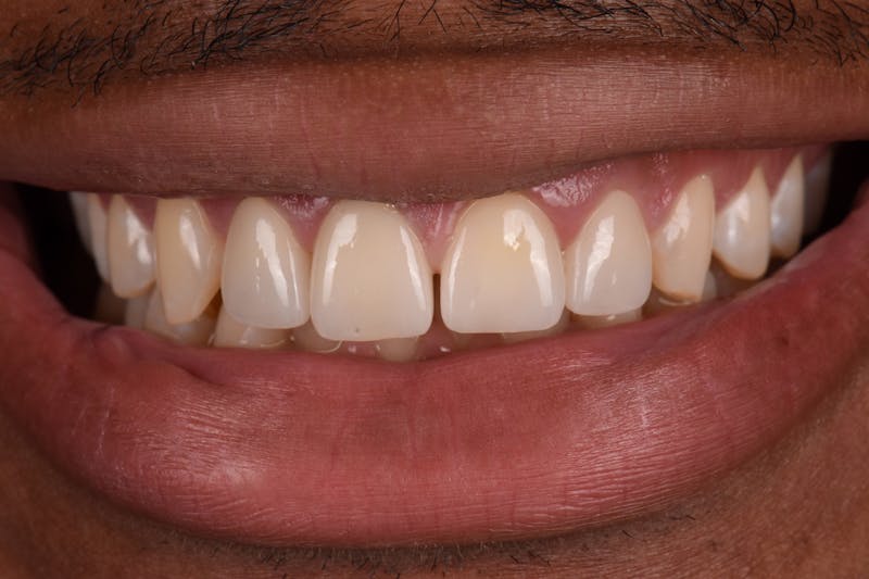 Patient Smile Before & After Gallery - Patient 107051 - Image 4
