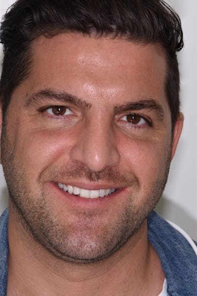 Patient Smile Before & After Gallery - Patient 198516 - Image 1