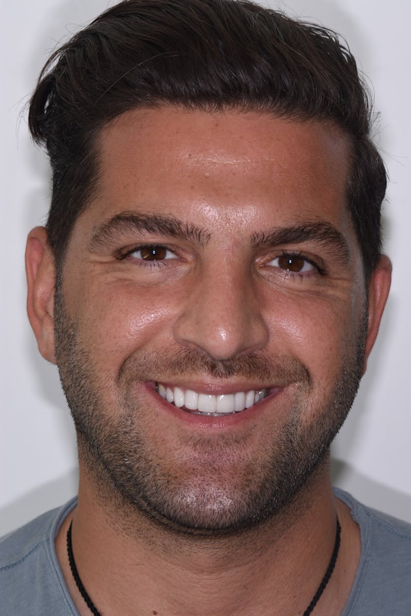 Patient Smile Before & After Gallery - Patient 198516 - Image 2