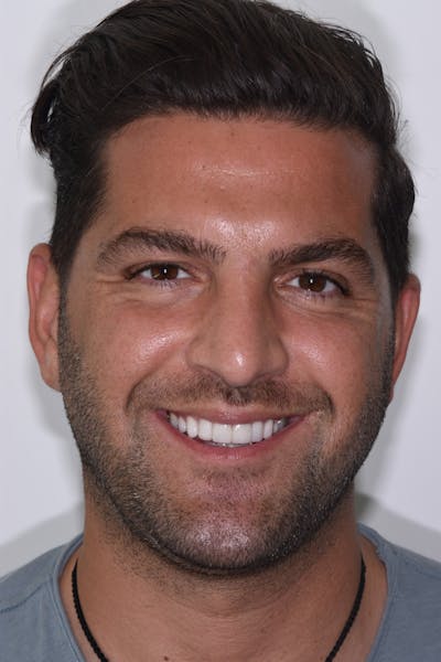 Patient Smile Before & After Gallery - Patient 198516 - Image 2