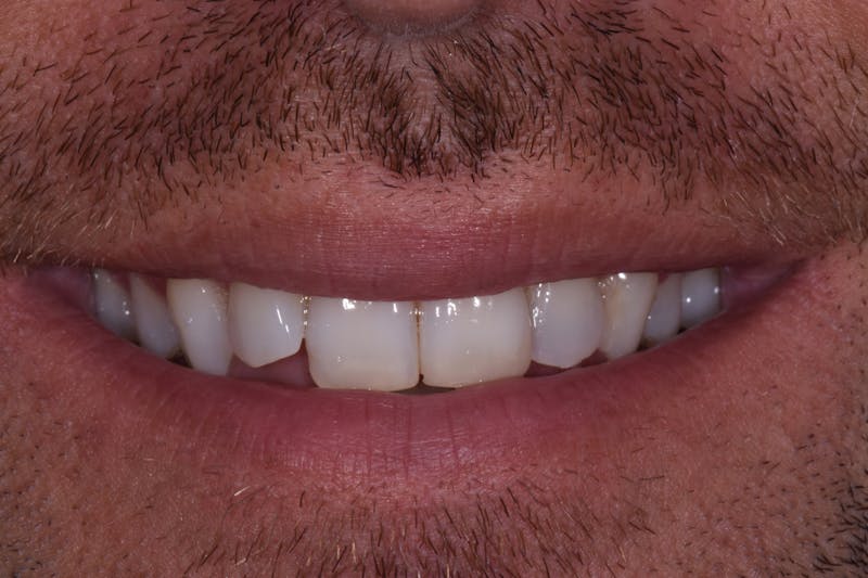 Patient Smile Before & After Gallery - Patient 198516 - Image 3