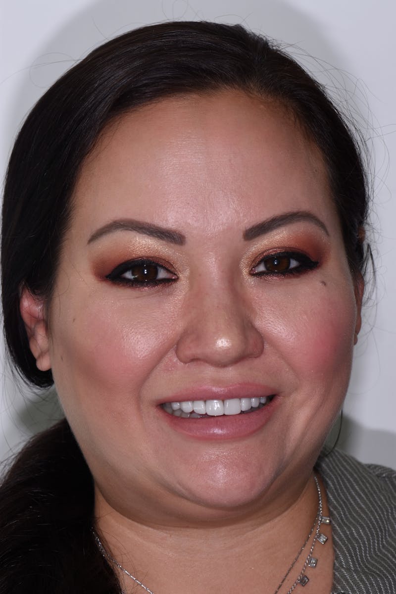 Patient Smile Before & After Gallery - Patient 190729 - Image 1