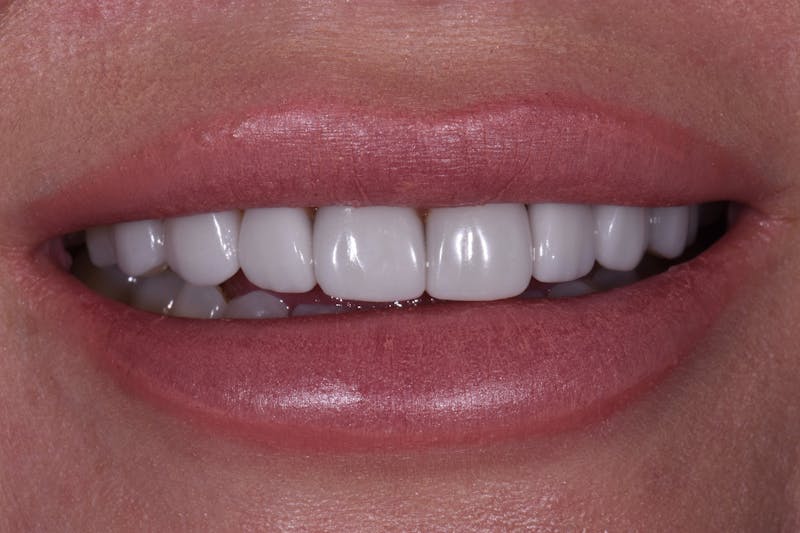 Patient Smile Before & After Gallery - Patient 190729 - Image 3