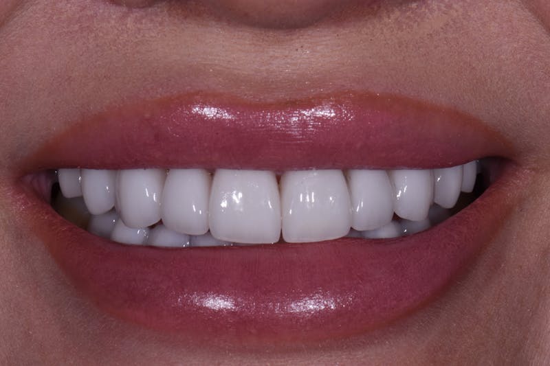 Patient Smile Before & After Gallery - Patient 190729 - Image 4