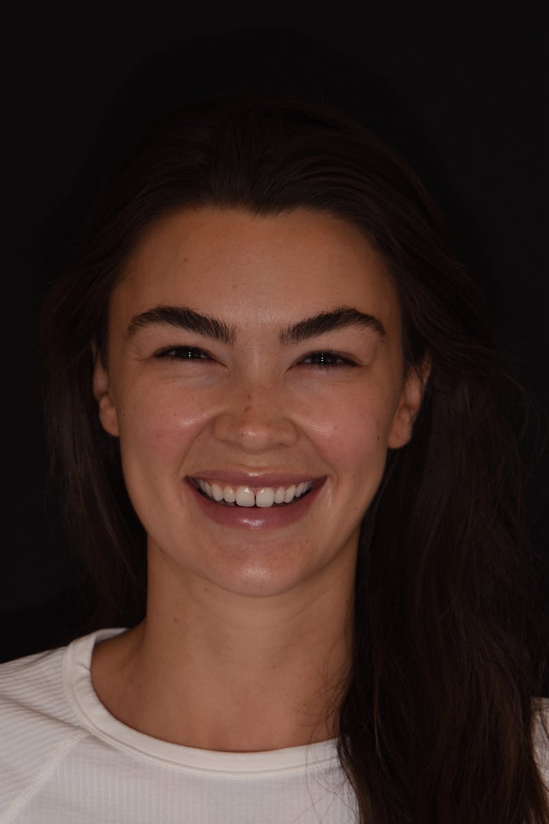 Patient Smile Before & After Gallery - Patient 402708 - Image 1