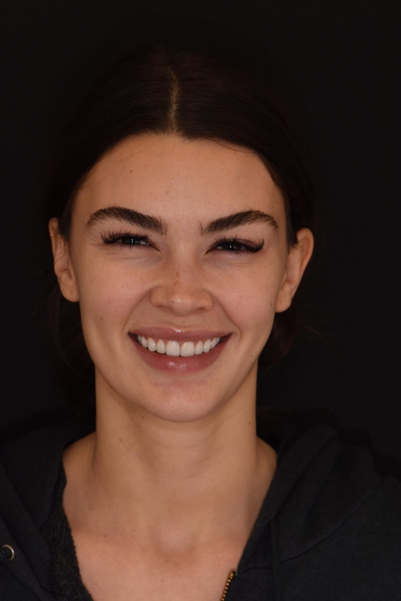 Patient Smile Before & After Gallery - Patient 402708 - Image 2