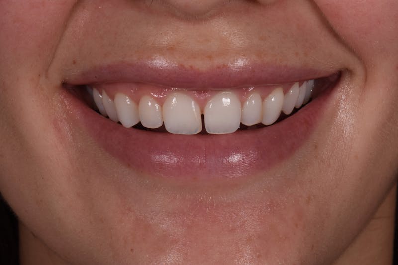 Patient Smile Before & After Gallery - Patient 402708 - Image 3