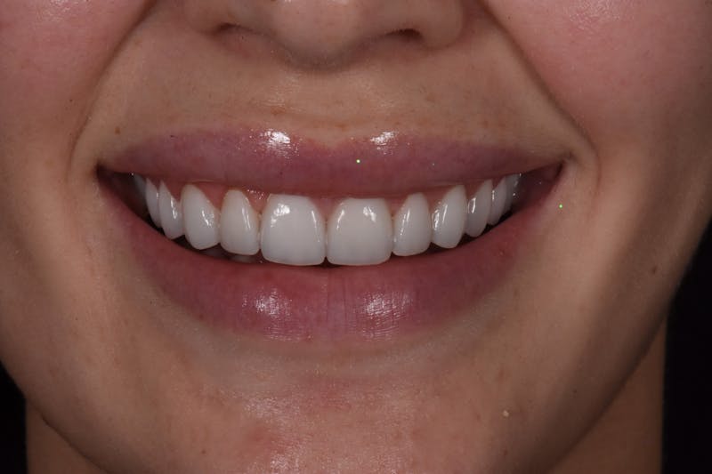 Patient Smile Before & After Gallery - Patient 402708 - Image 4