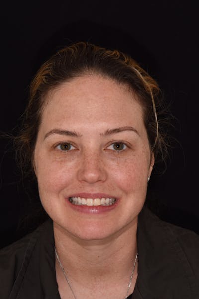 Patient Smile Before & After Gallery - Patient 236513 - Image 1