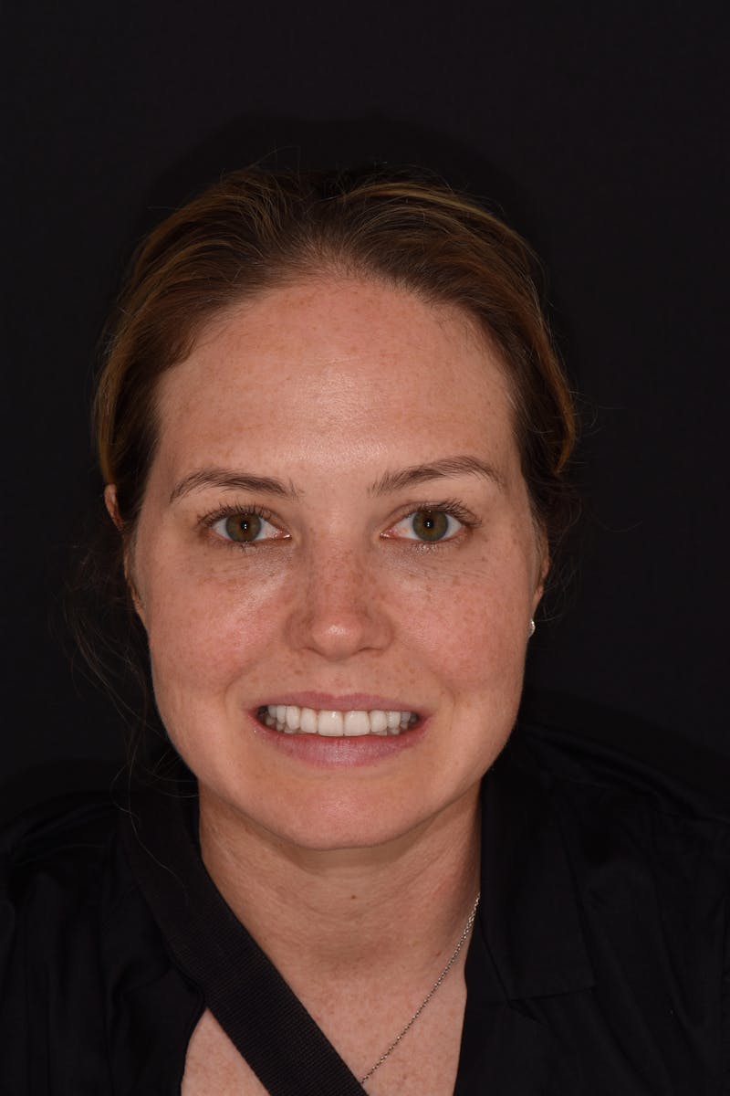 Patient Smile Before & After Gallery - Patient 236513 - Image 2