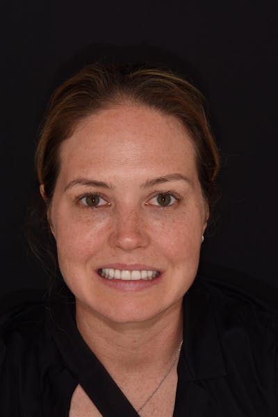 Patient Smile Before & After Gallery - Patient 236513 - Image 2