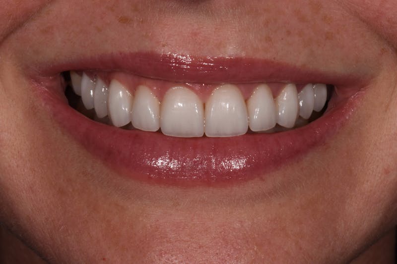 Patient Smile Before & After Gallery - Patient 236513 - Image 4