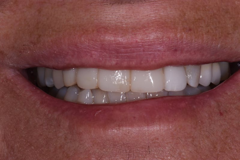 Patient Smile Before & After Gallery - Patient 686529 - Image 1