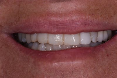 Patient Smile Before & After Gallery - Patient 686529 - Image 1