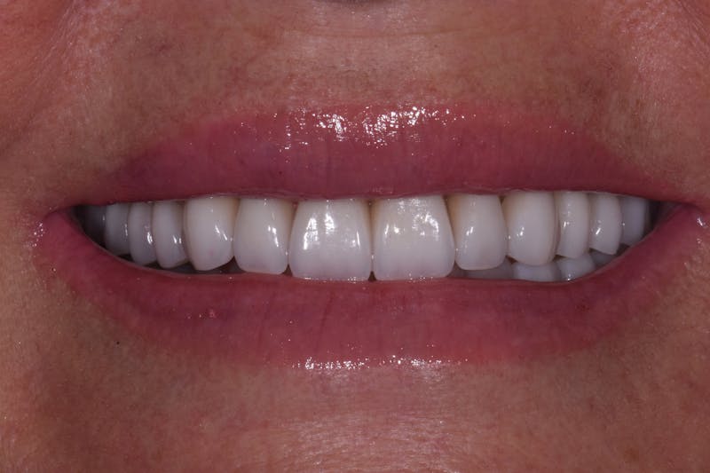 Patient Smile Before & After Gallery - Patient 686529 - Image 2