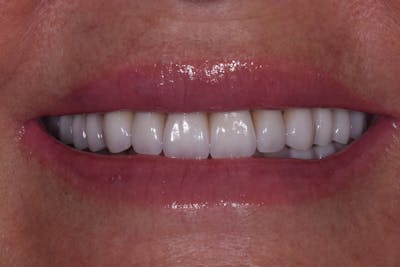 Patient Smile Before & After Gallery - Patient 686529 - Image 2
