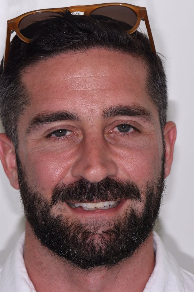 Patient Smile Before & After Gallery - Patient 171452 - Image 1