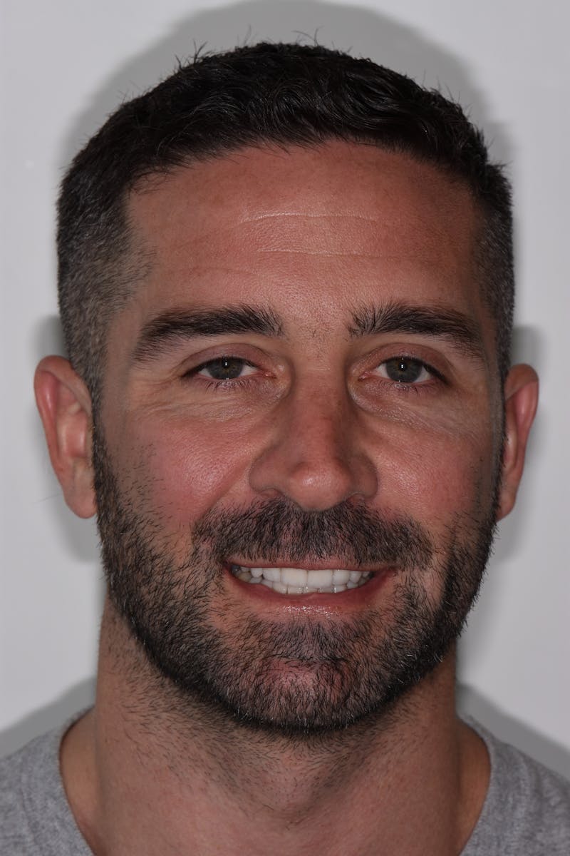 Patient Smile Before & After Gallery - Patient 171452 - Image 2