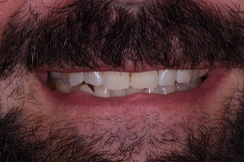 Patient Smile Before & After Gallery - Patient 171452 - Image 3