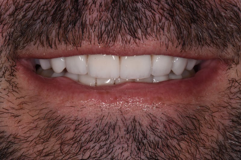 Patient Smile Before & After Gallery - Patient 171452 - Image 4