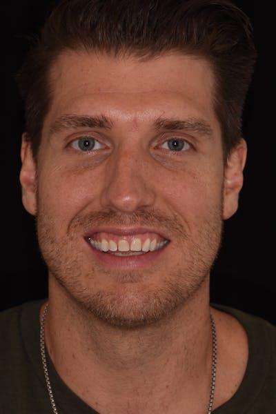 Patient Smile Before & After Gallery - Patient 885036 - Image 1