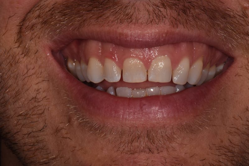 Patient Smile Before & After Gallery - Patient 885036 - Image 3