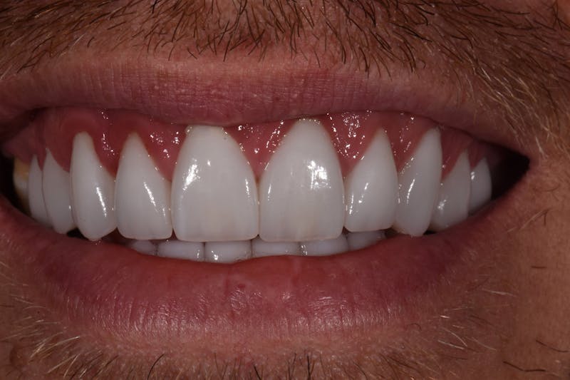 Patient Smile Before & After Gallery - Patient 885036 - Image 4