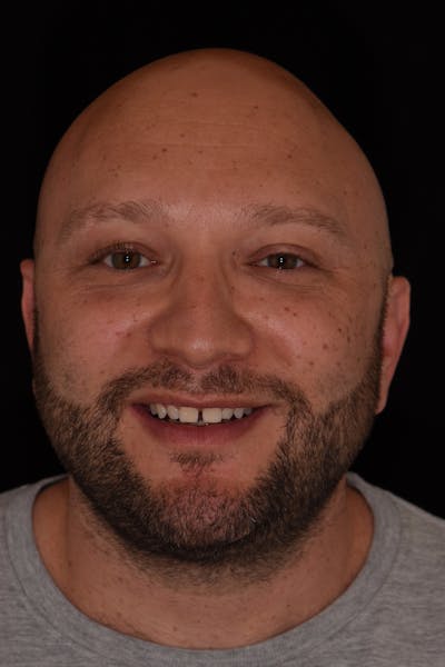 Patient Smile Before & After Gallery - Patient 396031 - Image 1