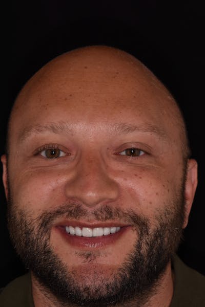 Patient Smile Before & After Gallery - Patient 396031 - Image 2